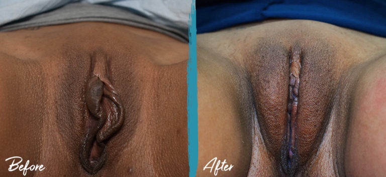 Before and after Labiaplasty