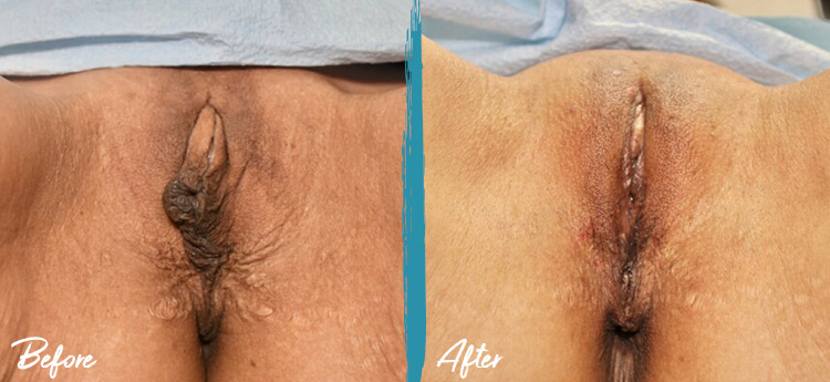 Image 3 before and after Labiaplasty, clitoral hood reduction, fat transfer to labia, and 3 sessions of co2re intima laser New Jersey