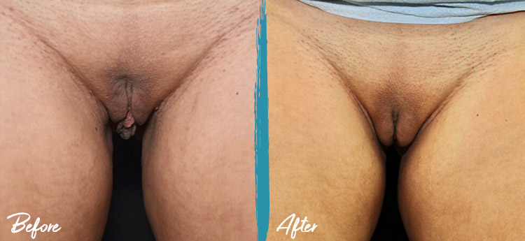 Image 5 before and after Labiaplasty, Clitoral hood reduction and fat transfer to labia New Jersey