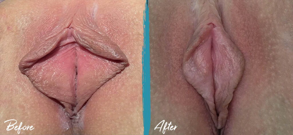 1 year post op vy wedge labiaplasty and clitoral hood reduction
