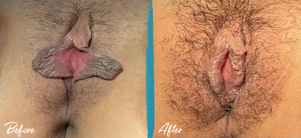 3.5 weeks post op linear labiaplasty with clitoral hood reduction
