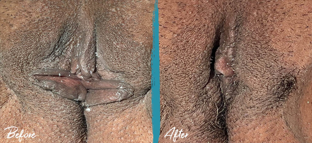 5 weeks post op labiaplasty and clitoral hood reduction