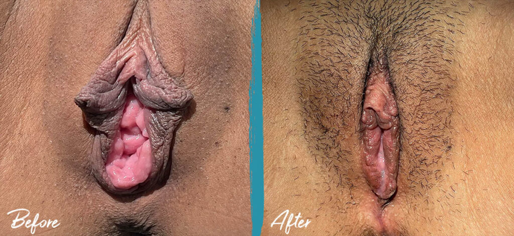 5 weeks post op vaginoplasty linear labiaplasty clitoral hood reduction