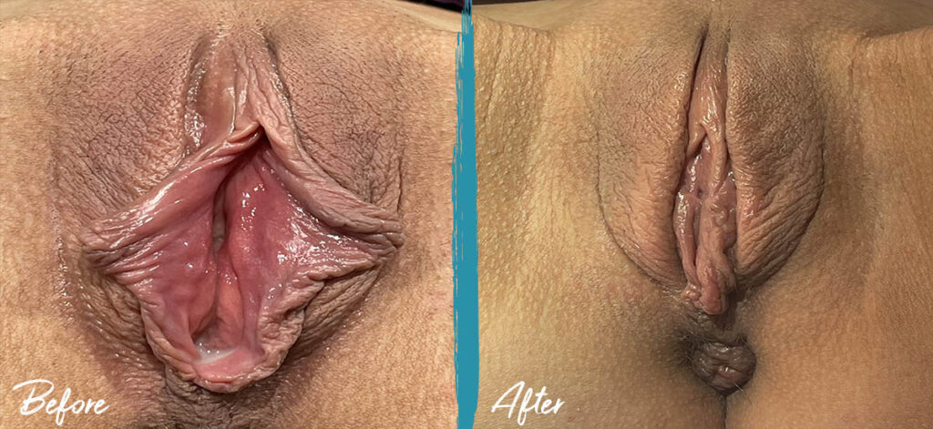 5 weeks post op vy wedge labiaplasty and clitoral hood reduction. pt. desired natural look