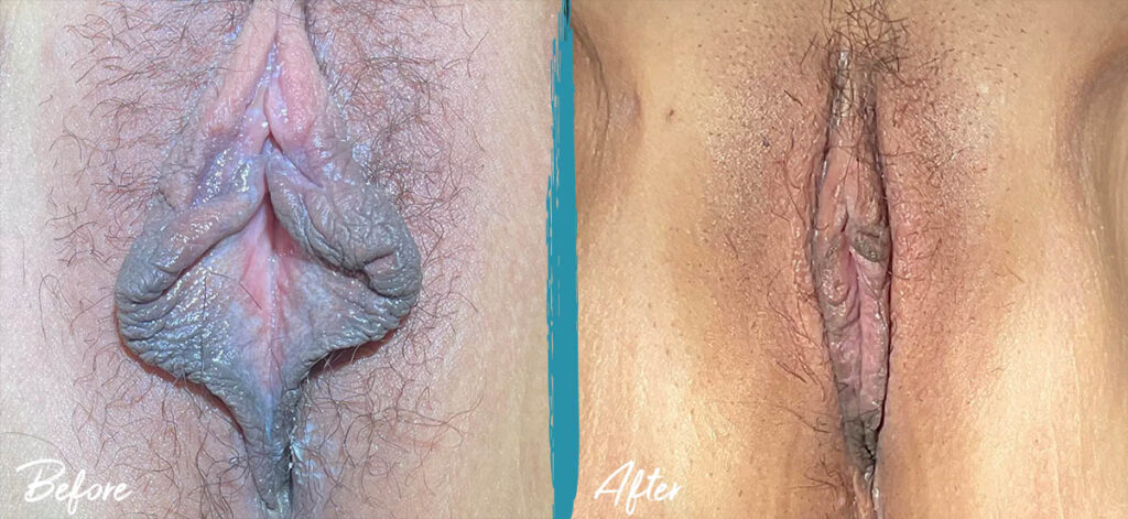 6 weeks post op labiaplasty with clitoral hood reduction
