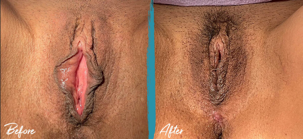 6 weeks post op vaginoplasty labiaplasty and clitoral hood reduction