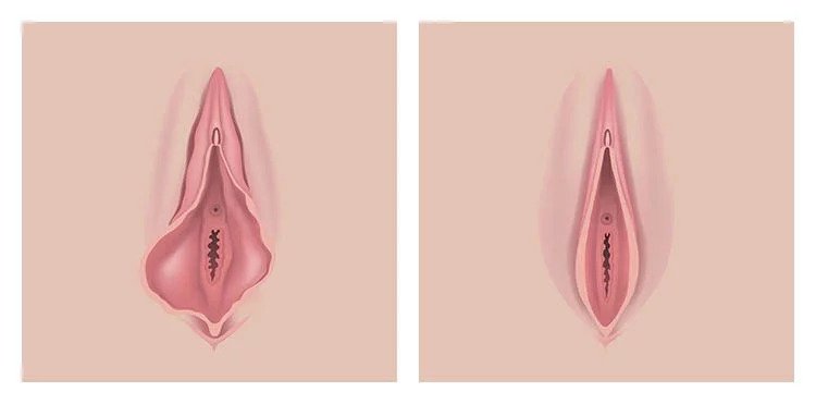 Vaginal Rejuvenation Before and After Photos