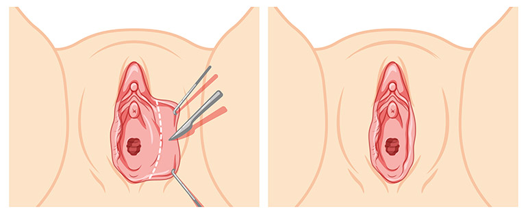 Labiaplasty surgery trim techniques