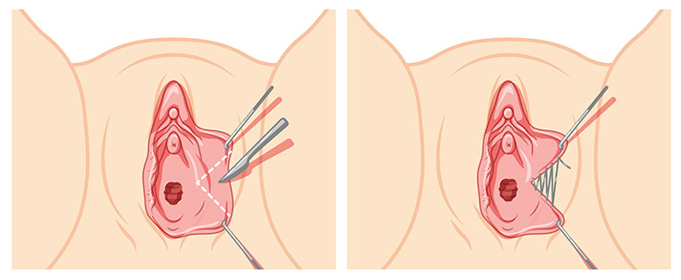 Labiaplasty surgery wedge techniques