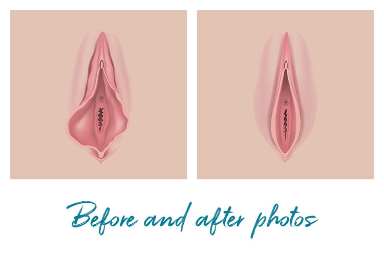Vaginal Rejuvenation procedures before and after photos Michigan