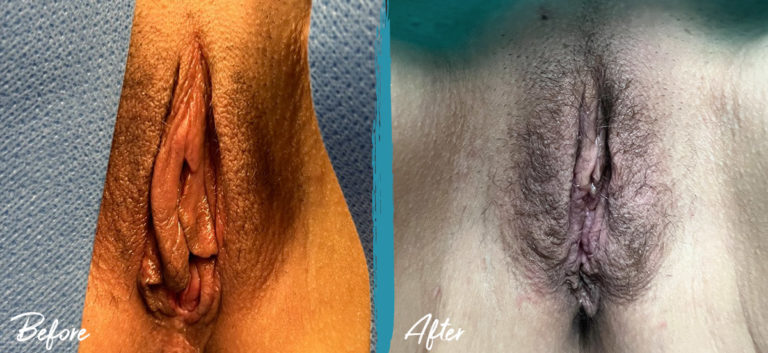 Labiaplasty Michigan Photo Before and After Patient 2023 04