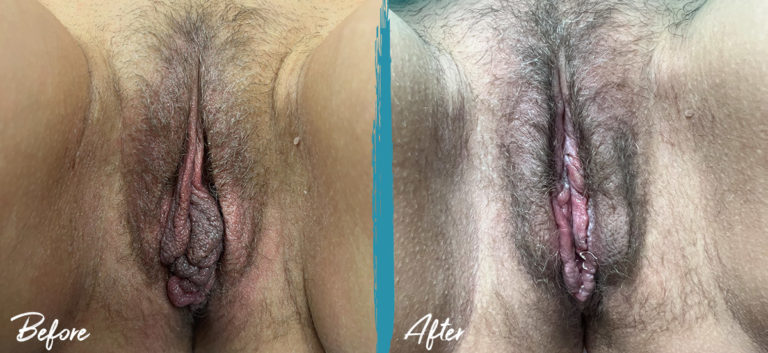 Labiaplasty Michigan Photo Before and After Patient 2023 05