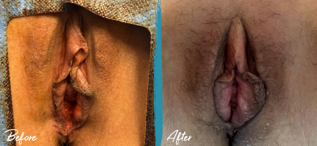 Vaginoplasty Michigan Photo Before and After Patient 2023 1