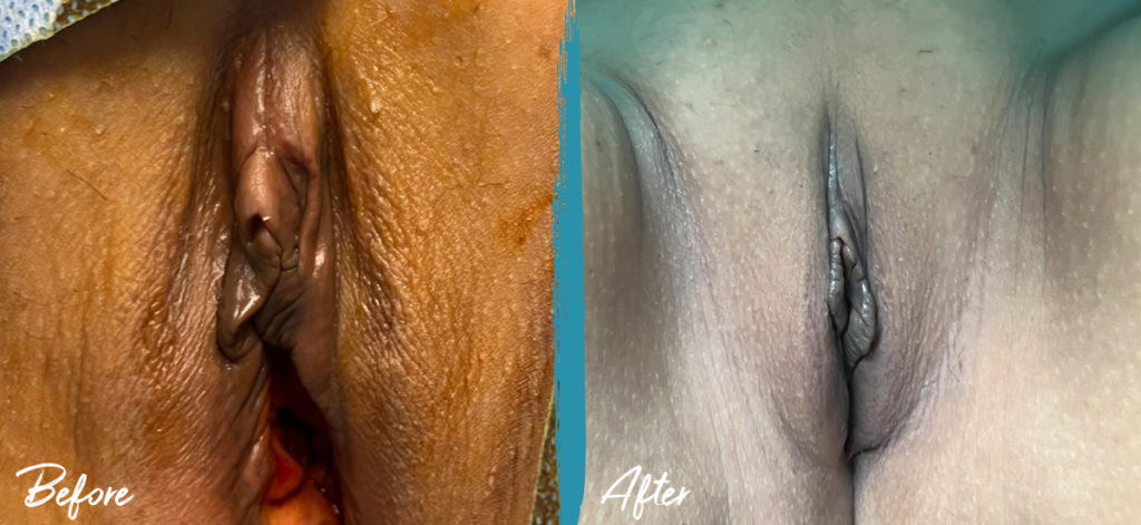 Vaginoplasty Michigan Photo Before and After Patient 2023 2