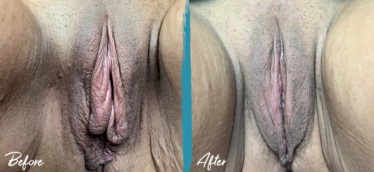 49 years old woman before and 6 weeks after Labiaplasty and Clitoral Hoodoplasty (Clitoral Hood reduction)