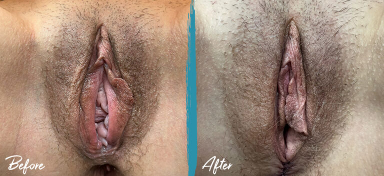 38 years old woman before Vaginoplasty and Perineoplasty and immediately after the surgery (day 1 picture)