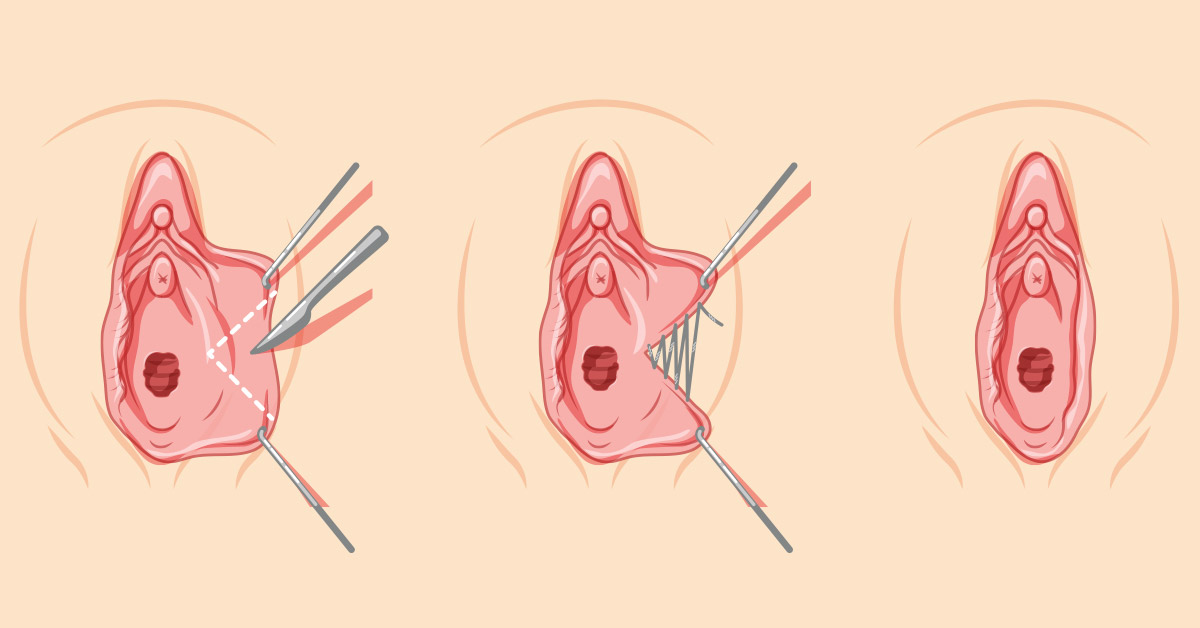 What is the Wedge Labiaplasty Technique in Michigan