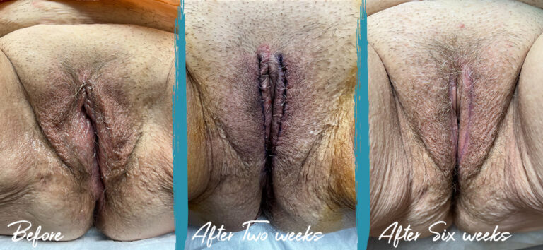 Labia Majoraplasty. Before, immediately after, and 6 weeks post-op.