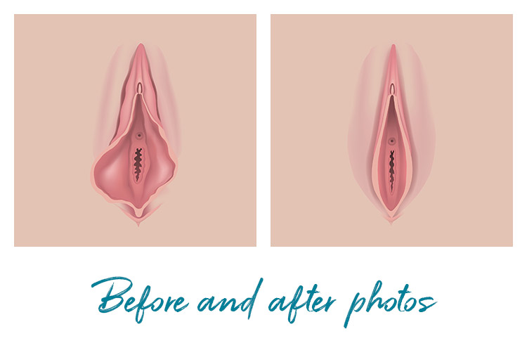 visible results in before and after vaginal tightening photos