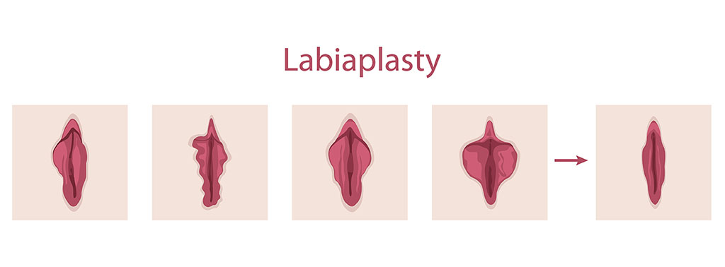 Diagnosis of Labial Hypertrophy