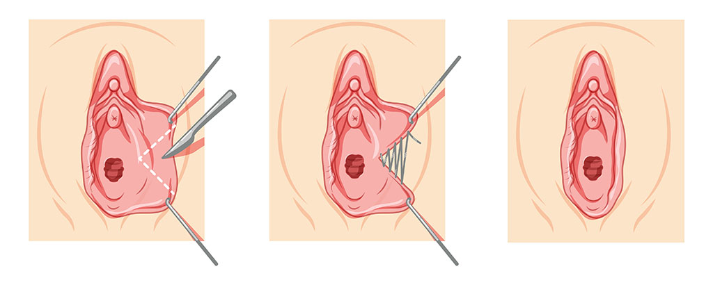 Treatment of Labial Hypertrophy