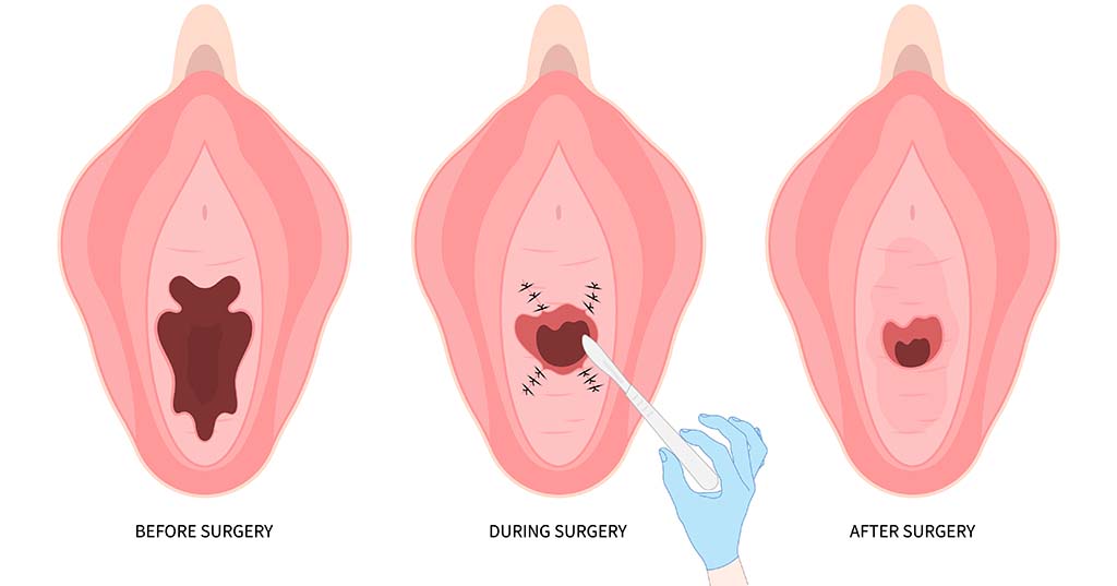 How Does Vaginoplasty Work for Vaginal Rejuvenation