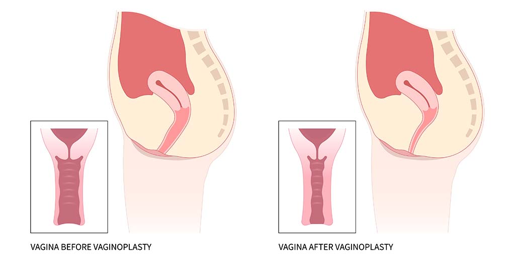 What Is Vaginoplasty? Understanding the Procedure, Types, and Results