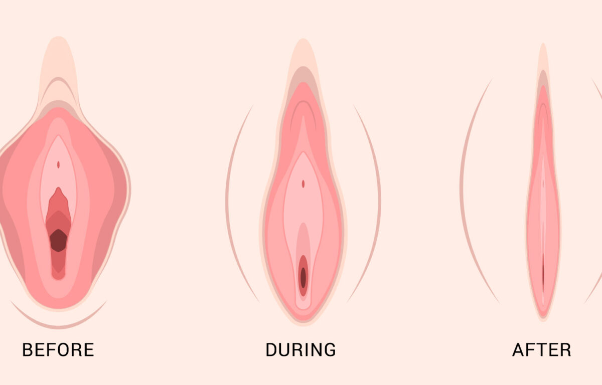 Fat Transfer Labia Puffing Cost