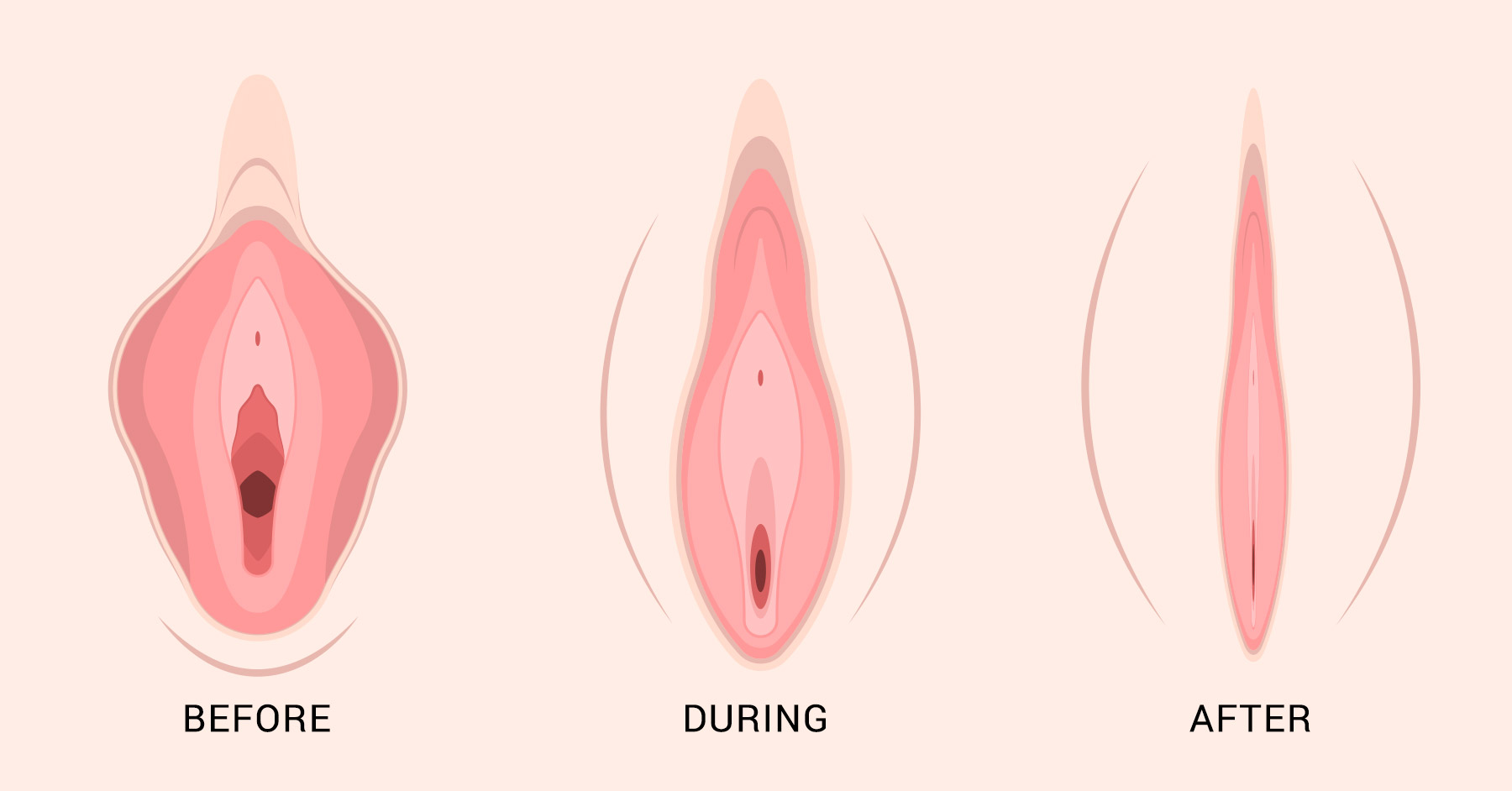 Fat Transfer Labia Puffing Cost