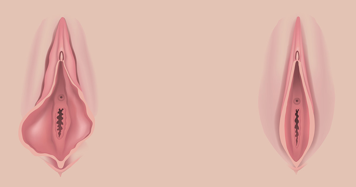 Does Labial Hypertrophy Go Away