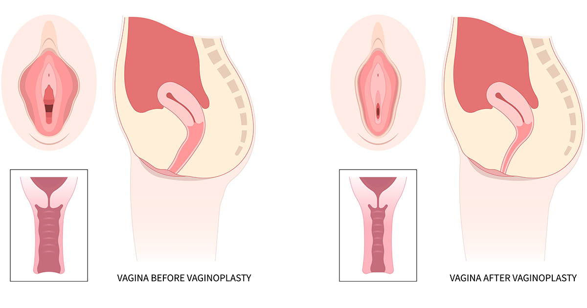 How to Tighten the Vagina After Childbirth or Aging Safe and Effective Options