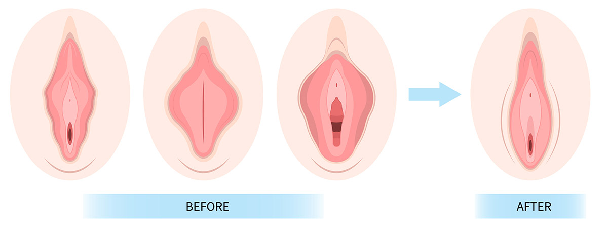 Labial Hypertrophy and Vaginal Rejuvenation