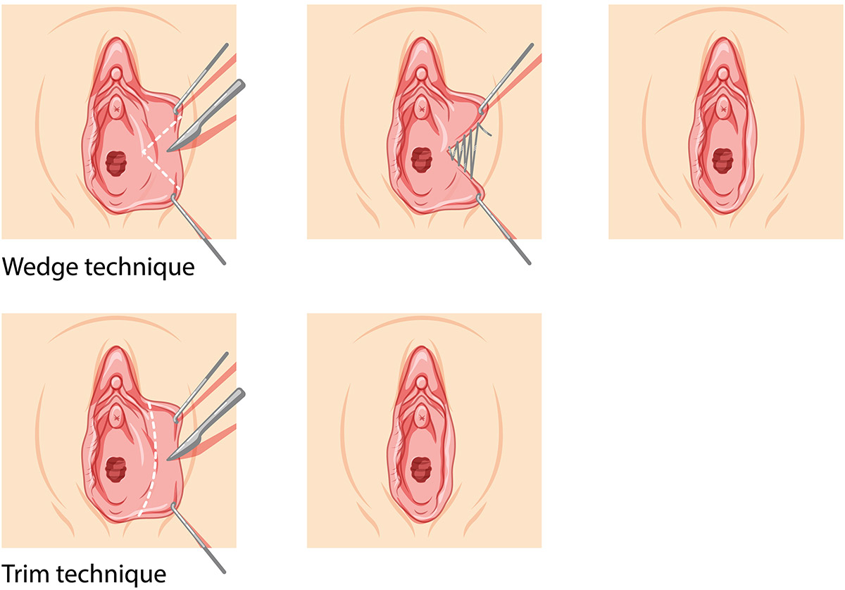 Labiaplasty Trim and Wedge Techniques